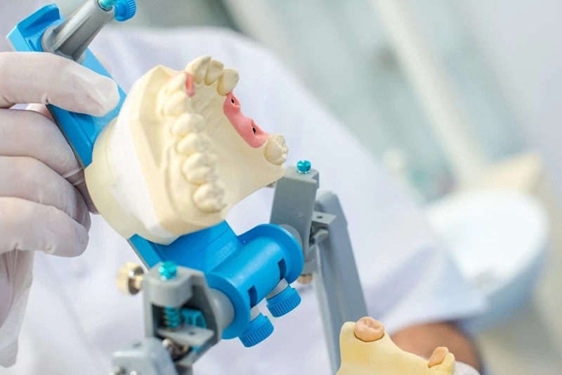 Modello dentale montato in articolatore durante la lavorazione di una protesi a Pomezia