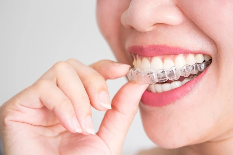 Applicazione di una mascherina trasparente per ortodonzia invisibile in uno studio dentistico a Pomezia